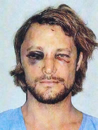 Gabriel Aubry- image of his face after the fight